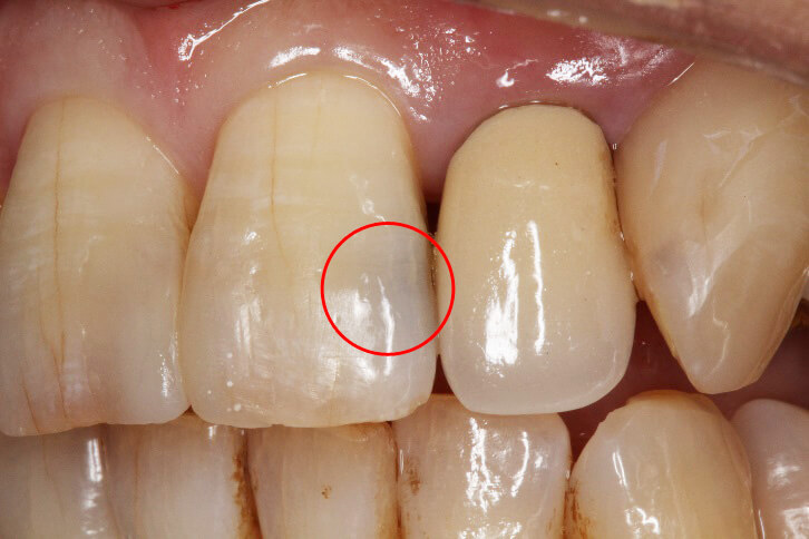 前歯部 コンポジットレジン修復 治療例 その1