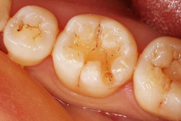 臼歯部 コンポジットレジン修復 治療例 その3