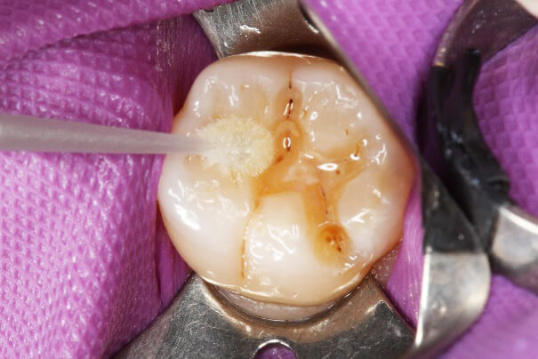 臼歯部 コンポジットレジン修復 治療例 その5