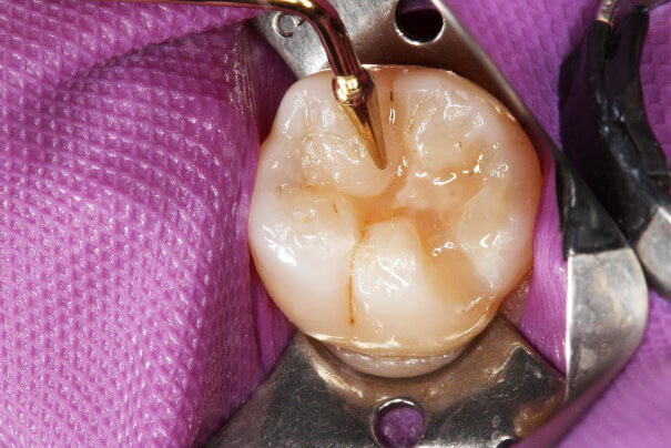 臼歯部 コンポジットレジン修復 治療例 その8