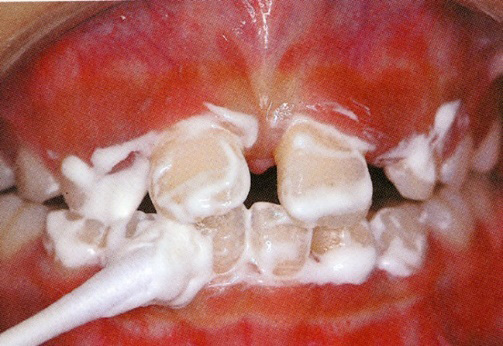 フッ素塗布・再石灰化療法　再石灰化を促す特殊なペーストを歯全体に塗布