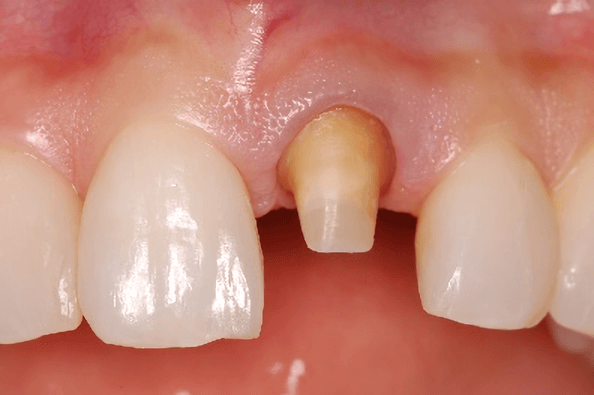 補綴物治療の流れ　支台歯形成