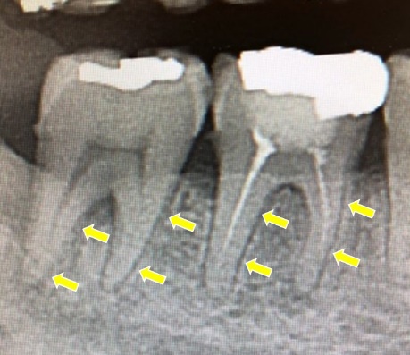 「歯根膜炎」の一例　葉山の歯医者 川本歯科医院
