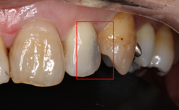 川本歯科医院　ダイレクトボンディング治療例4 治療前 上顎左側側切歯のう蝕の様子