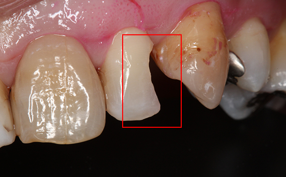 川本歯科医院　ダイレクトボンディング治療例4 治療中 浸潤麻酔下にてう蝕を除去