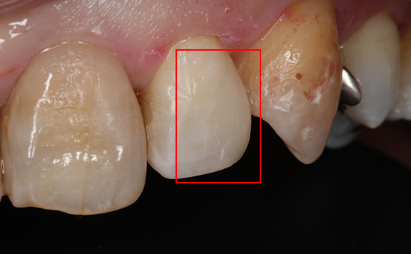 川本歯科医院　ダイレクトボンディング治療例4 治療後 コンポジットレジンにて修復
