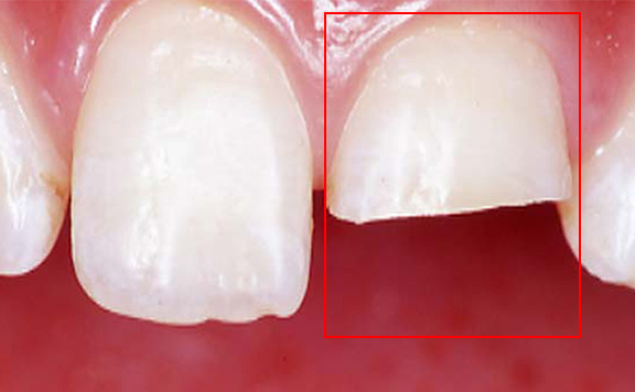 川本歯科医院　ダイレクトボンディング治療例5 治療前 上顎左側中切歯の歯冠破折の様子