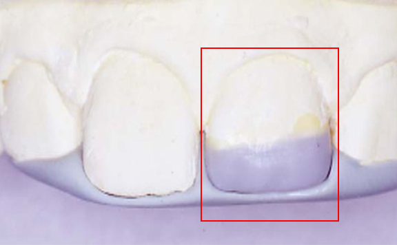 川本歯科医院　ダイレクトボンディング治療例5 治療中1 印象採得の様子