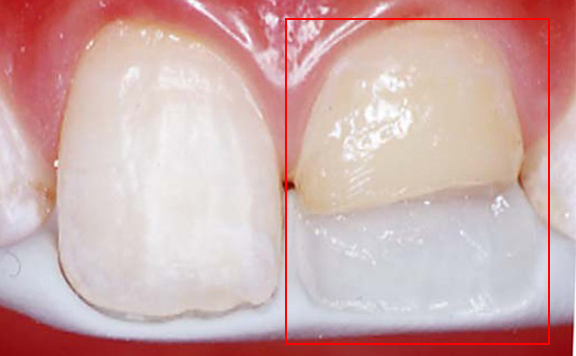 川本歯科医院　ダイレクトボンディング治療例5 治療中2 ワックスアップの様子
