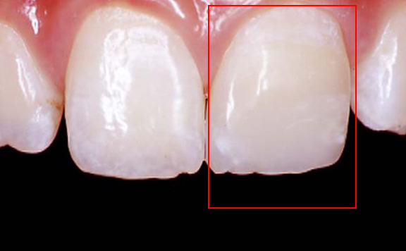 川本歯科医院　ダイレクトボンディング治療例5 治療後 コンポジットレジンにて直接修復