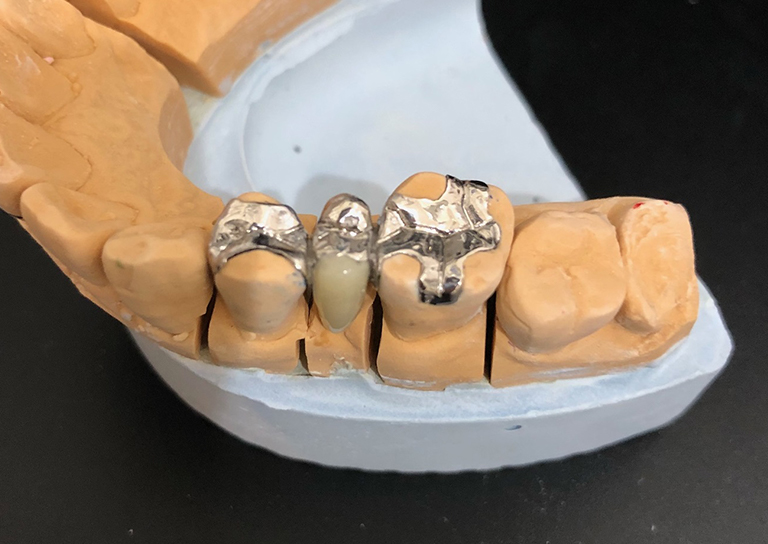 インレーブリッジ