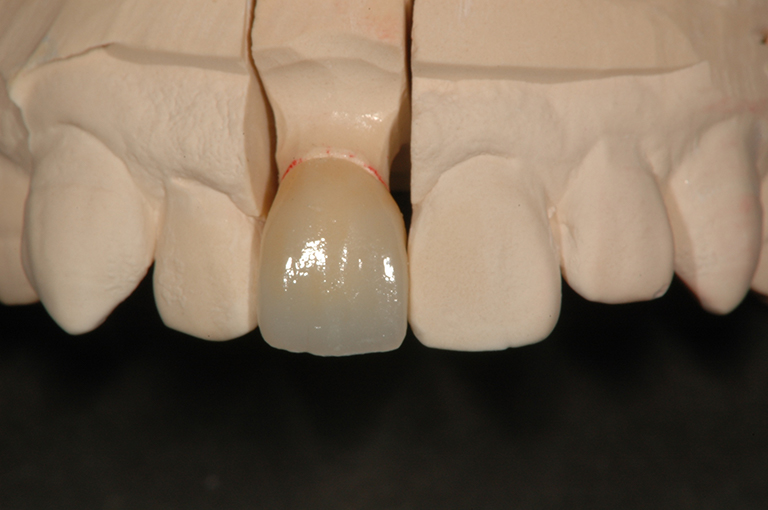 セラミッククラウン e.max