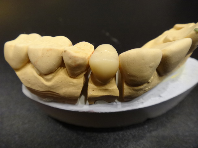 レジンジャケットクラウン