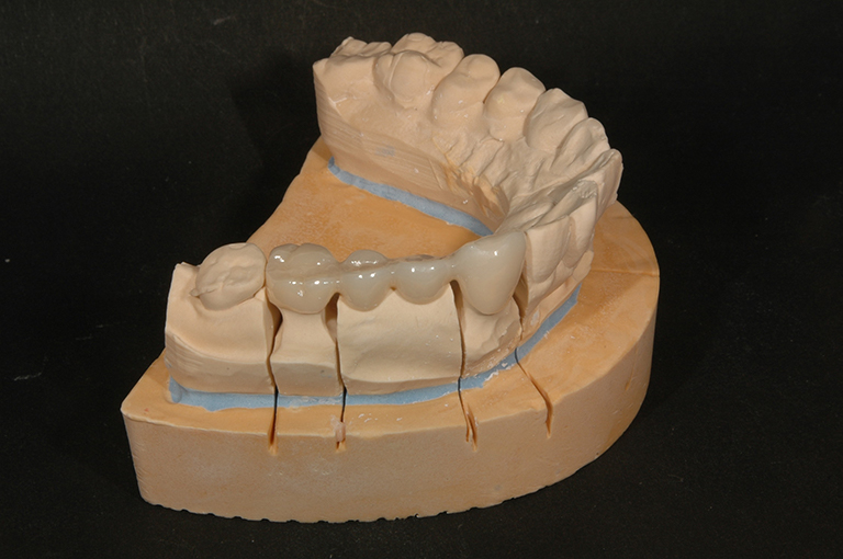 ジルコニアブリッジ